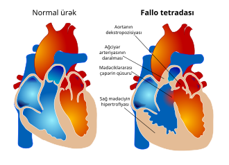 Fallo tetradasının morfoloji qurluşunun təsviri