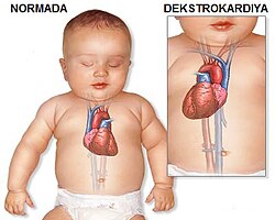 Ürəyin sağda yerləşməsi